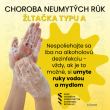 Hepatitída A